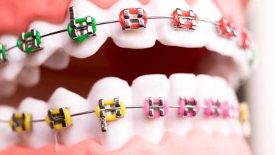 Transforming Smiles in Carle Place: The Ultimate Guide to Braces