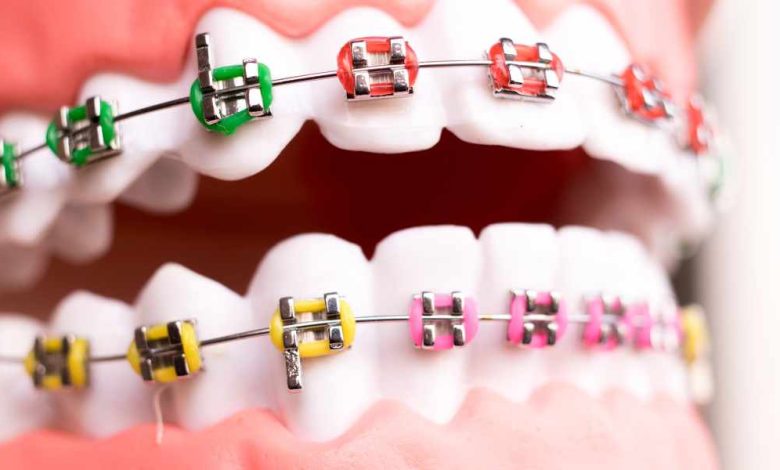 Transforming Smiles in Carle Place: The Ultimate Guide to Braces